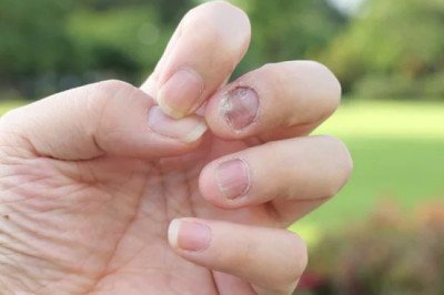 An Onychomycosis Treatment Eliminates The Fungus And Promotes Nail Growth