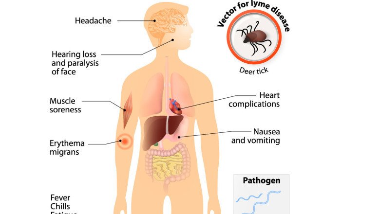 Lyme Disease Treatment Market Overview Analysis, Growth Factor and Forecast to 2028